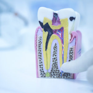 Dental tooth model cast showing decay enamel roots